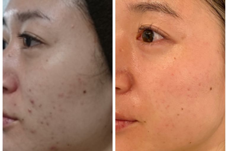 リアボーテのクレアスキンの効果☆大阪の正規店