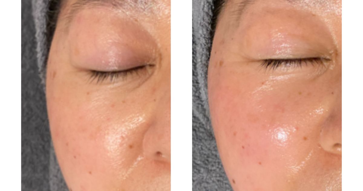 大阪 フェイシャルエステ】グランスキン リアボーテ インフィニット の効果