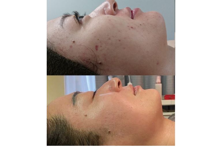 大阪 フェイシャルエステ】グランスキン リアボーテ インフィニット の効果