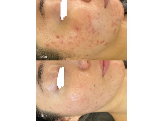 シェリースキン　効果