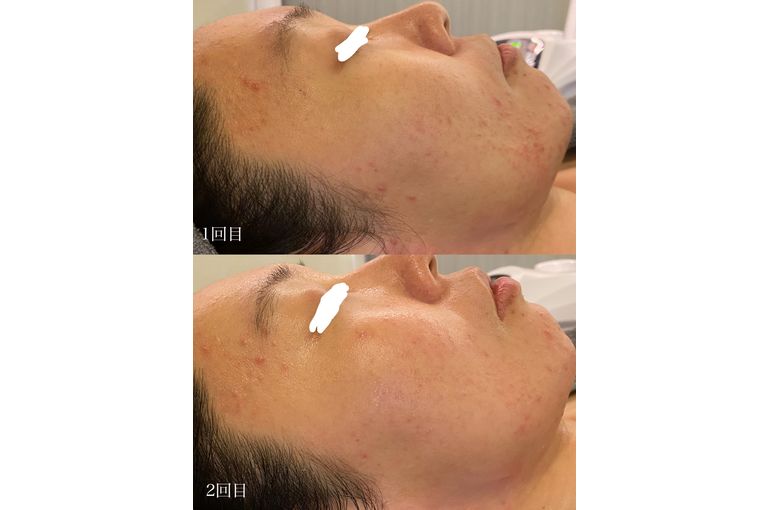 大阪 フェイシャル】シェリースキン クレンジング 洗顔 効果