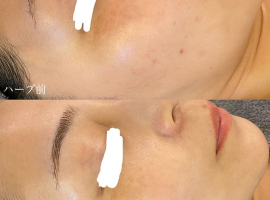 ハーブトリートメント