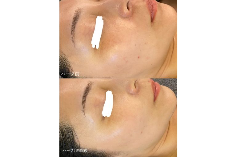 ハーブトリートメント