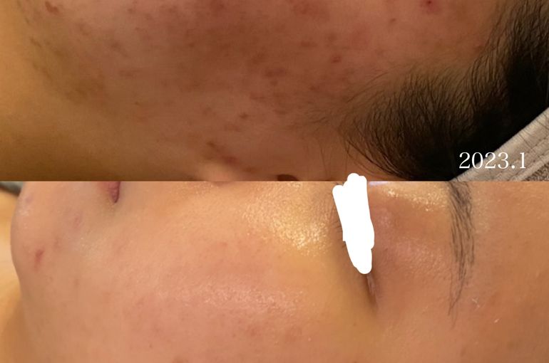 シェリースキン ニキビ