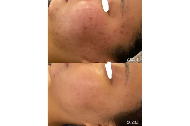 シェリースキン ニキビ