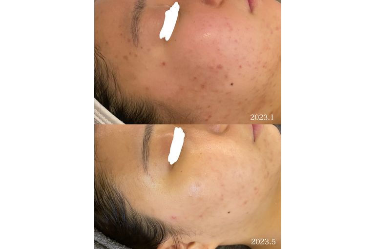 シェリースキン ニキビ