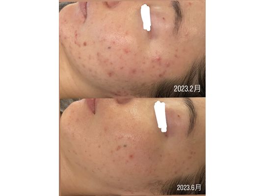 シェリースキン ニキビ