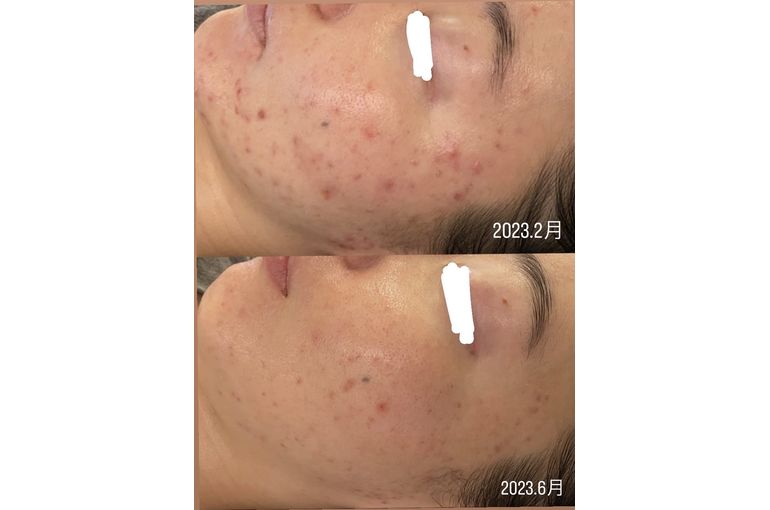 シェリースキン ニキビ