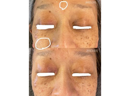 ハーブトリートメント 効果