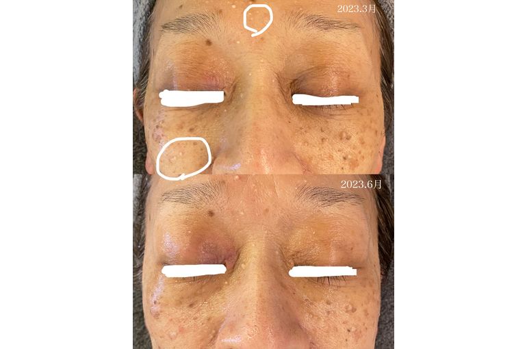 ハーブトリートメント 効果