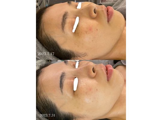 リアボーテ　グランスキン