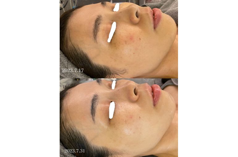 リアボーテ　グランスキン