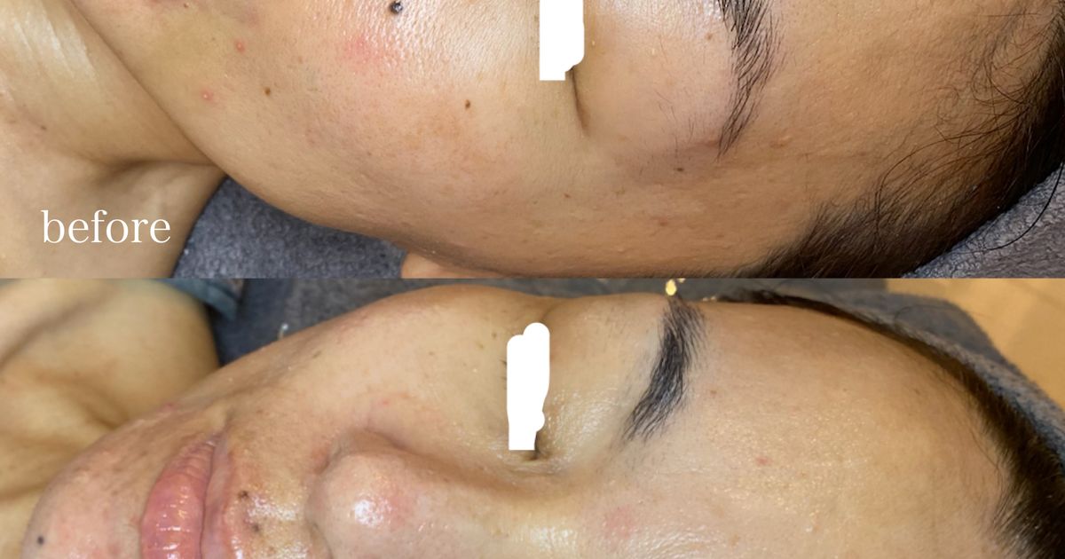 リアボーテ 大阪】グランスキン ヴィーナス 効果