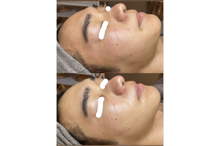 プレケアエッセンス　効果