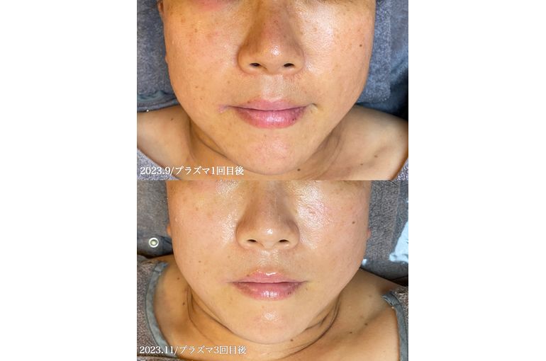 プラズマフェイシャル　大阪