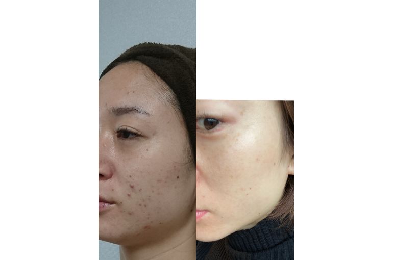 リアボーテ　シェリースキン