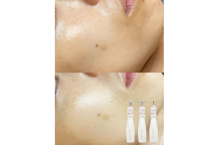 プラズマフェイシャル　シミ