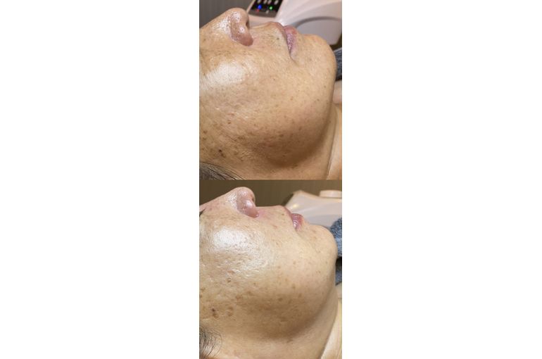 プラズマフェイシャル　効果