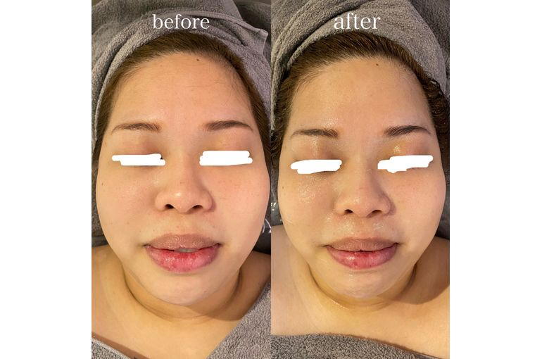 リアボーテ 大阪】ACトリートメント 効果 1回