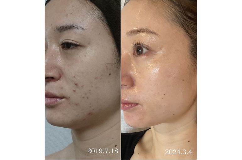 リアボーテ　ハーブトリートメント