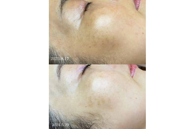 リアボーテ　シェリースキン