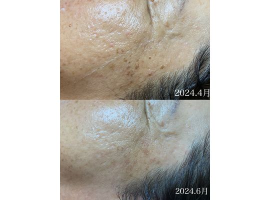 リアムール　エキスパートローション