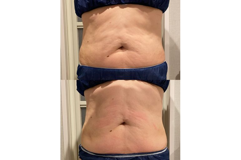 リアボーテ　ディゾセラム