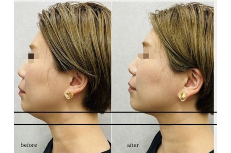 リアボーテ　ディゾデラム