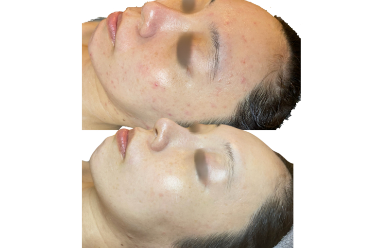 リアボーテ　シェリースキン