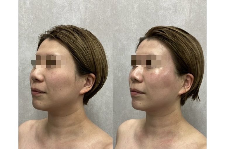 リアボーテ　ハーブトリートメント