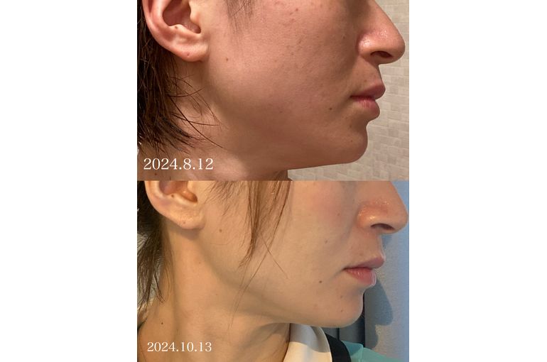 リアボーテ　ディゾセラム