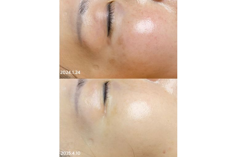 リアボーテ　クレアスキン