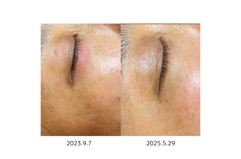 リアボーテ　シェリースキン