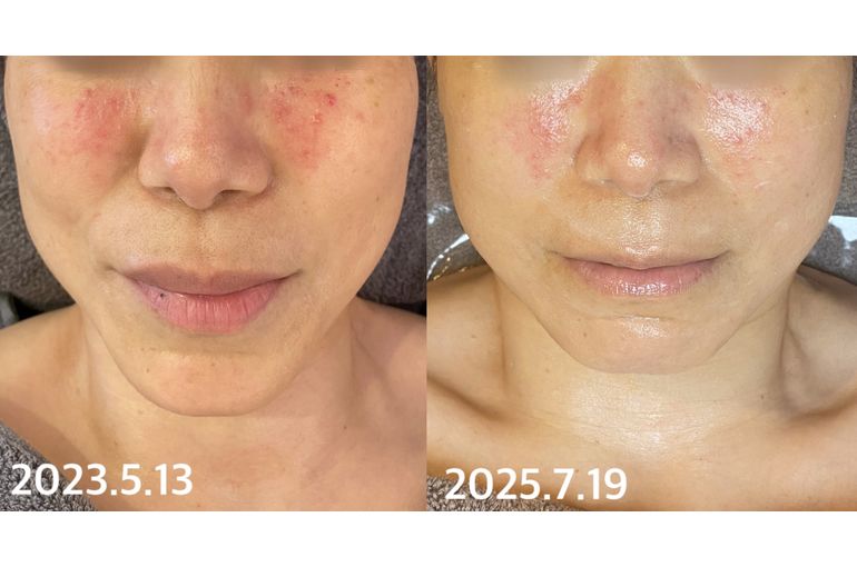 リアボーテ　シェリースキン