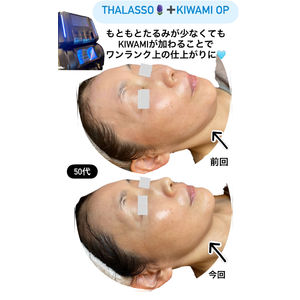 ボーテデラボ　kiwami