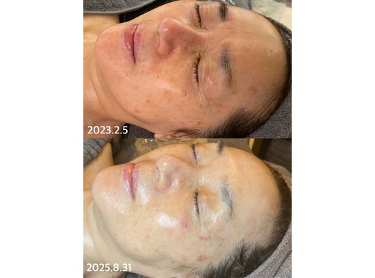 リアボーテ　クレアスキン