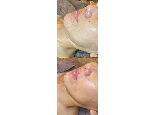 リアボーテ　クレアスキン