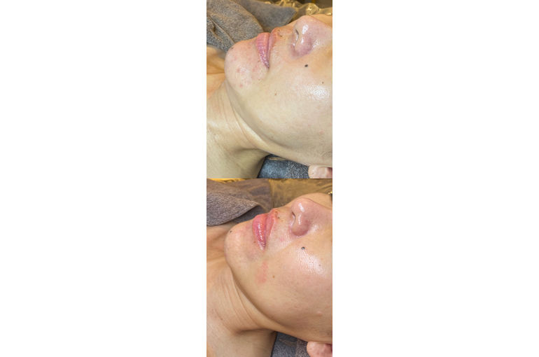 リアボーテ　クレアスキン