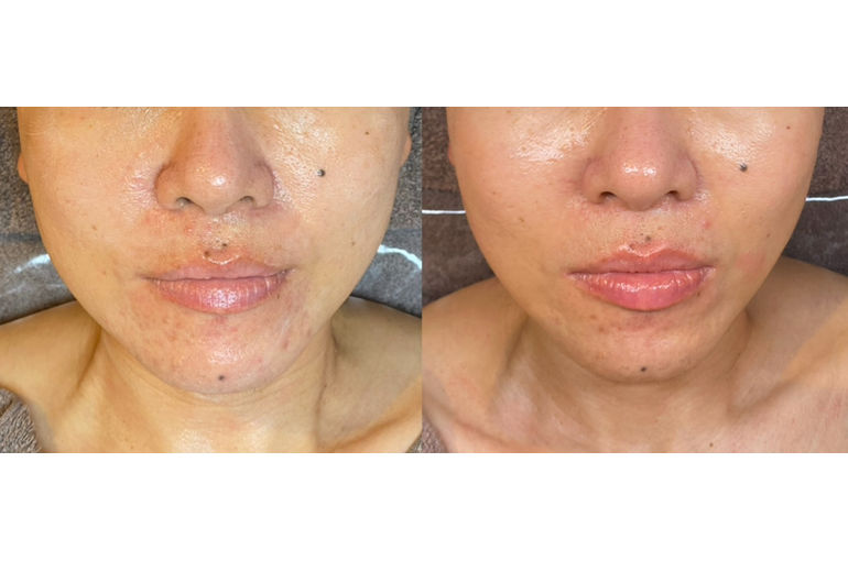 リアボーテ　クレアスキン