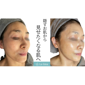 大阪 フェイシャルエステ】グランスキン リアボーテ インフィニット の効果