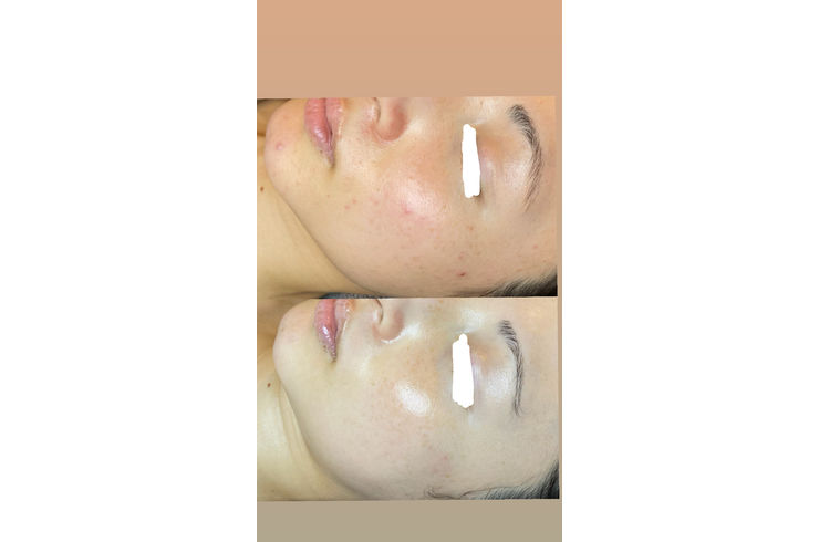 リアボーテ　シェリースキン