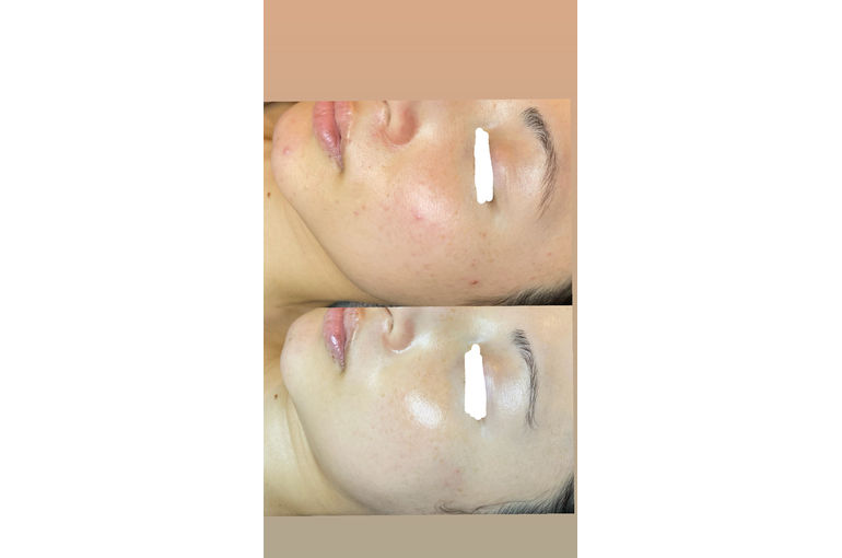 リアボーテ　シェリースキン