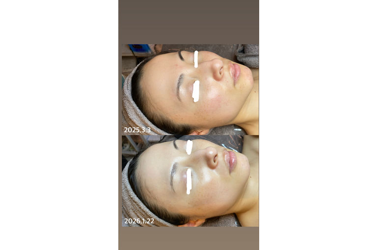 リアボーテ　シェリースキン