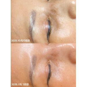 大阪 フェイシャルエステ】グランスキン リアボーテ インフィニット の効果