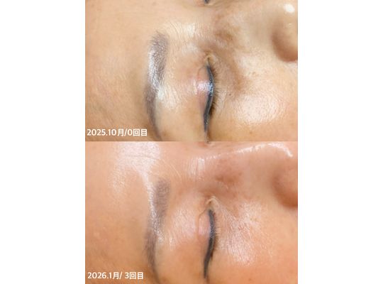 ボーテデラボ　kiwami