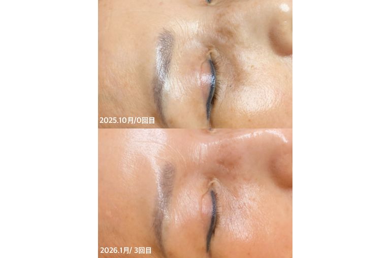 ボーテデラボ　kiwami